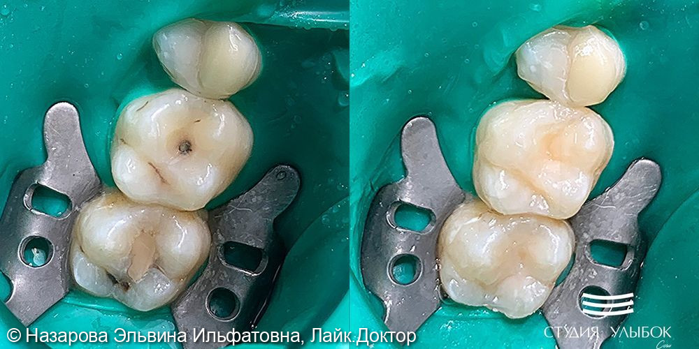 Лечение среднего кариеса 16 и 17 зубов у девушки 25-ти лет - фото №2