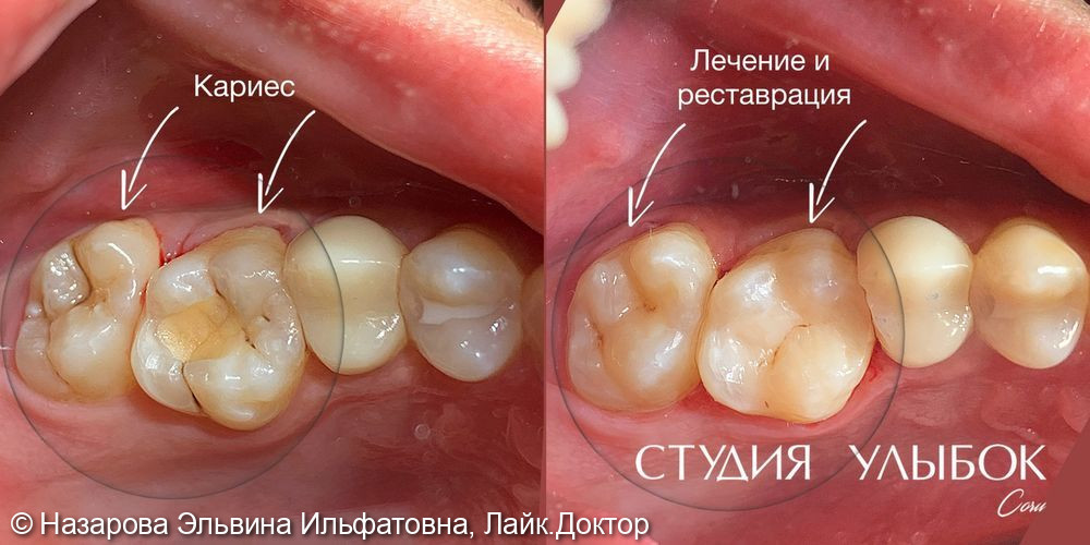 Лечение кариеса дентина 26,27 зубов - фото №1