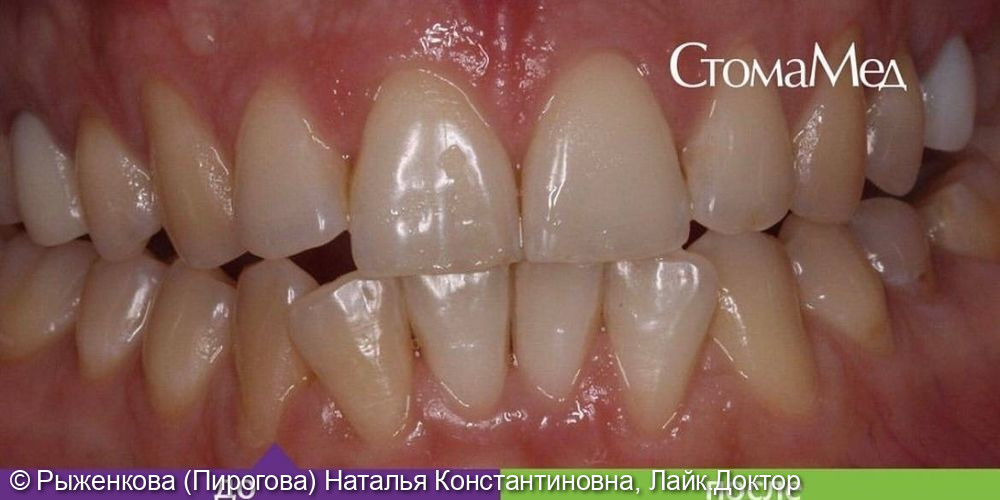 Отбеливание зубов по системе ZOOM-4 - фото №1