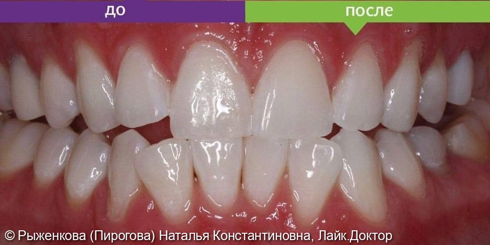 Отбеливание зубов по системе ZOOM-4 - фото №2