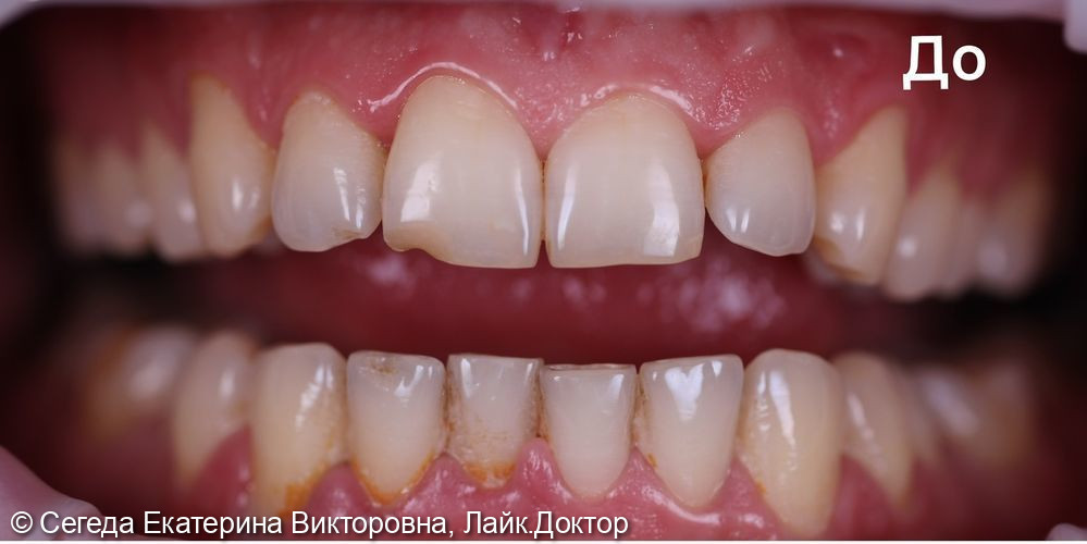 Профессиональная гигиена полости рта и зубов - фото №1