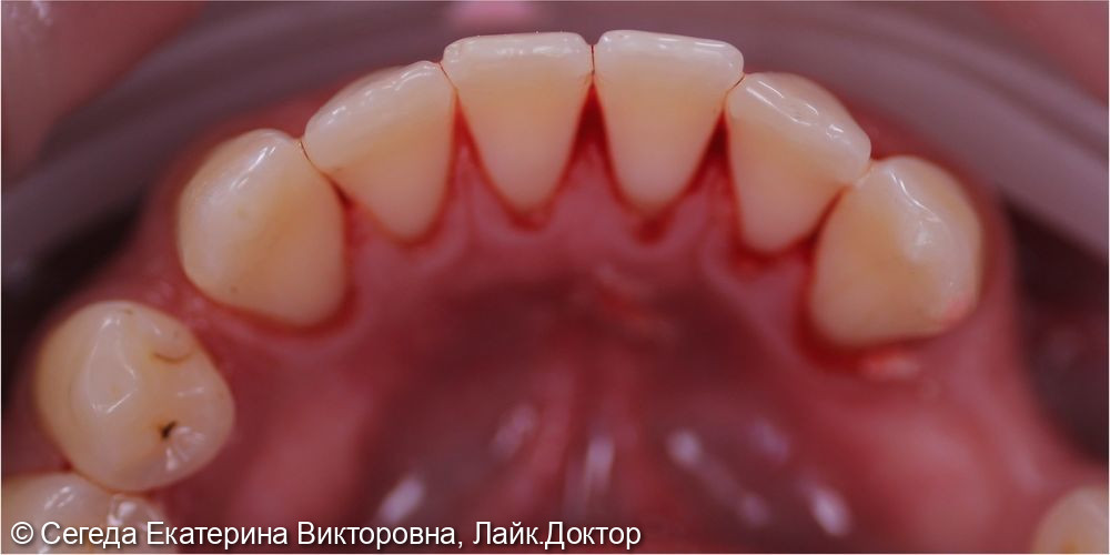 Профессиональная гигиена полости рта и зубов - фото №2