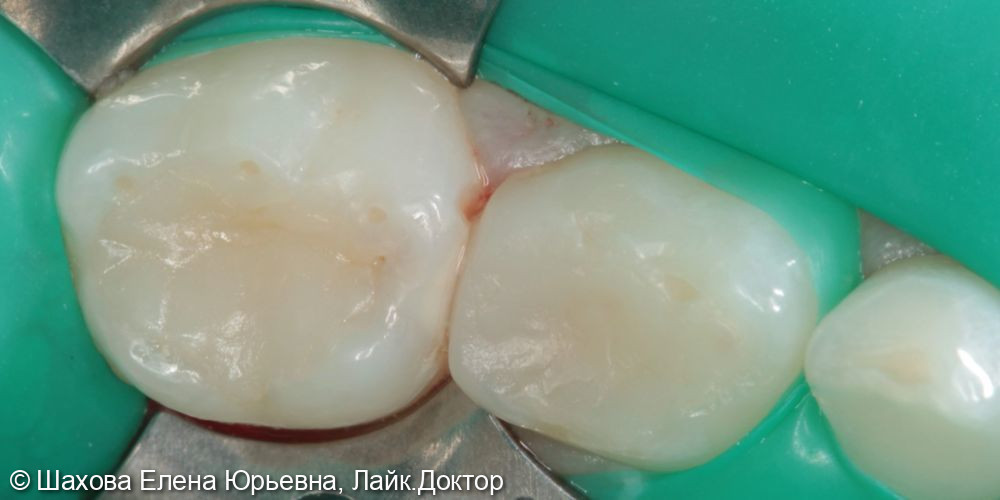 Лечение глубокого кариеса зуба 75 - фото №1