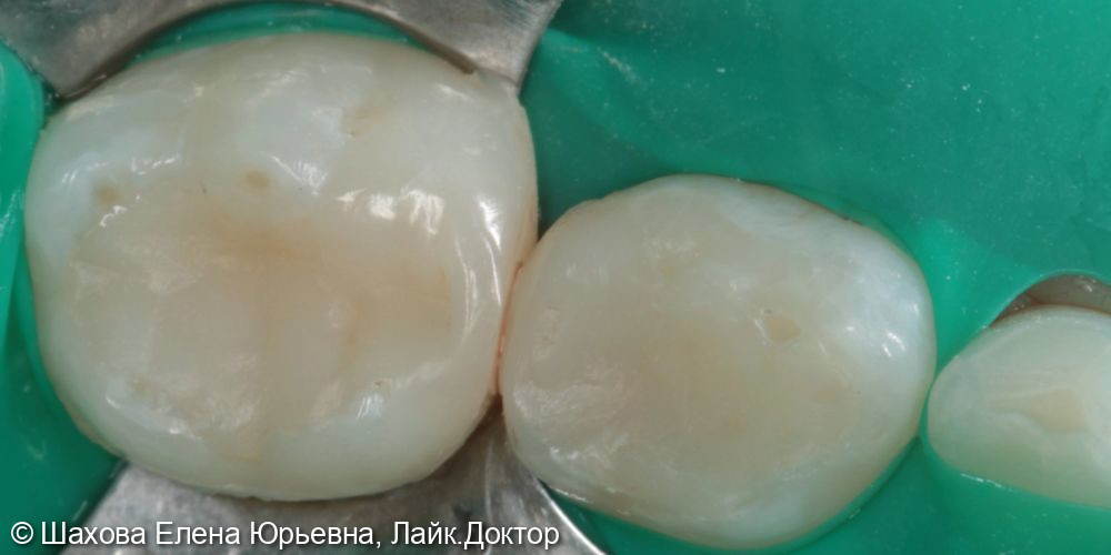 Лечение глубокого кариеса зуба 75 - фото №4