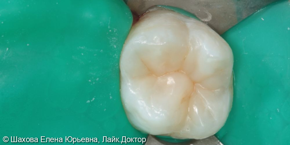 Лечение вторичного кариеса зуба 26 - фото №4