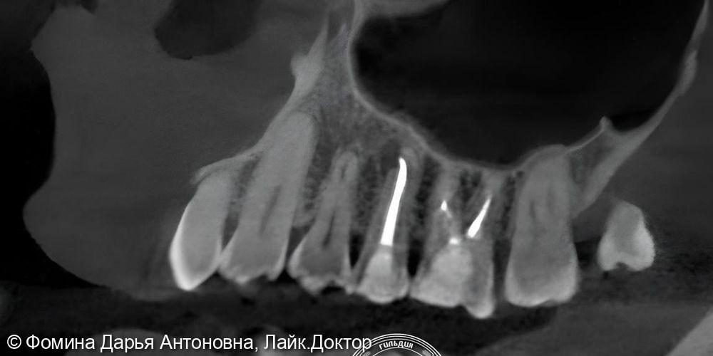 Повторное эндодонтическое лечение - фото №1