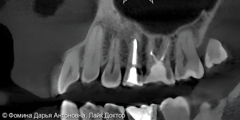 Повторное эндодонтическое лечение - фото №2