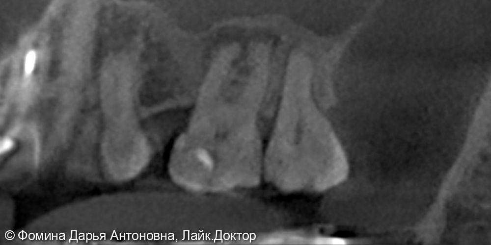 Воспаление на верхушках корней - фото №1