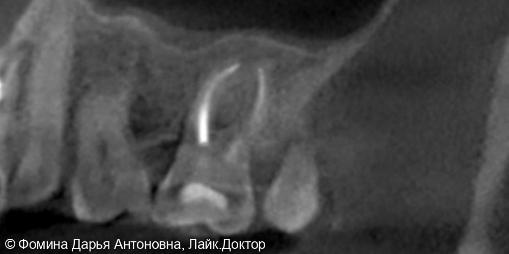 Воспаление на верхушках корней - фото №2