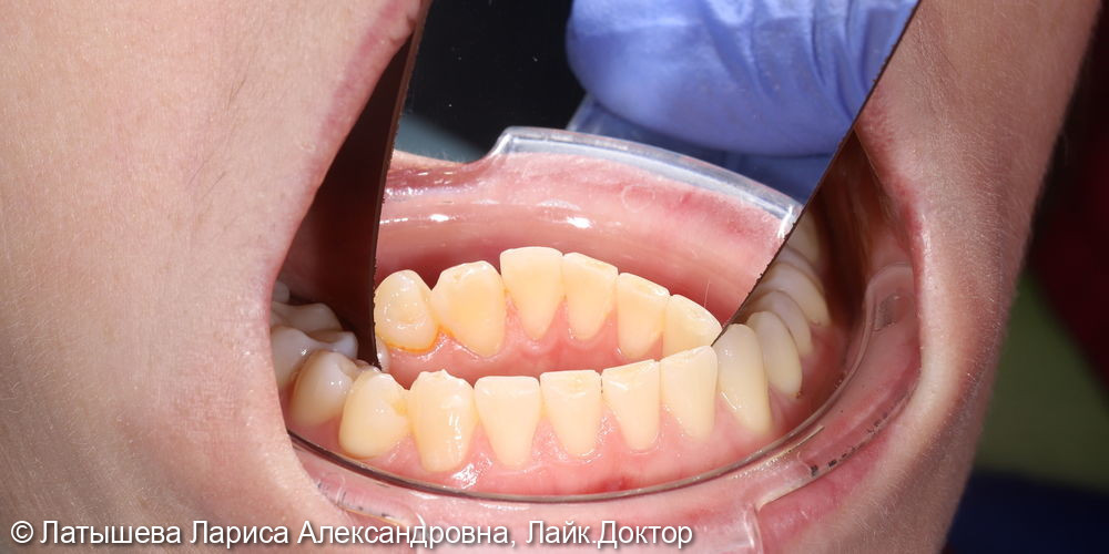 реставрация 42 зуба (травматический скол режущего края ) - фото №2