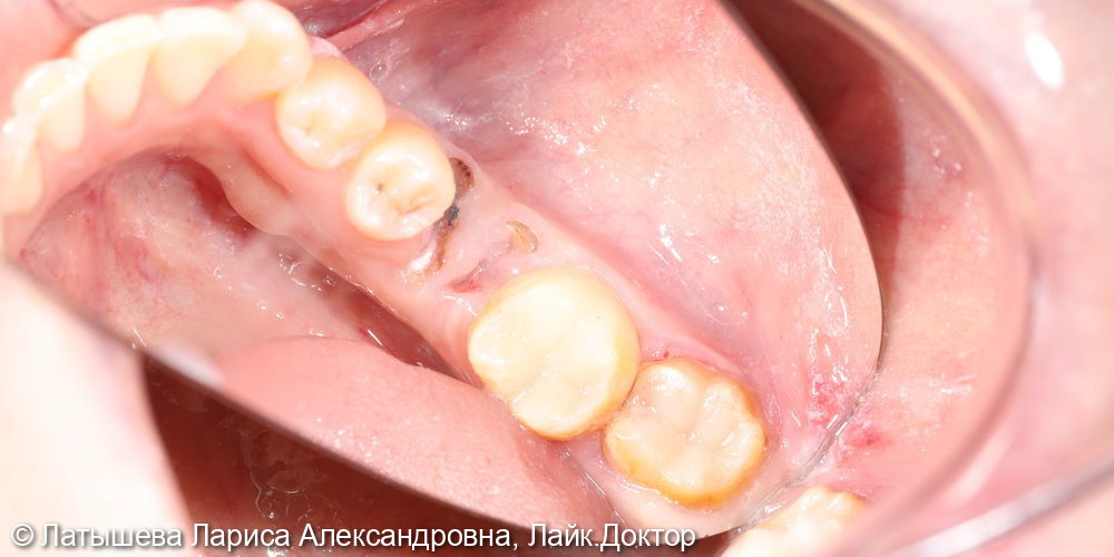 Лечение глубокого кариеса 4.7 ; 4.8 зуба - фото №2