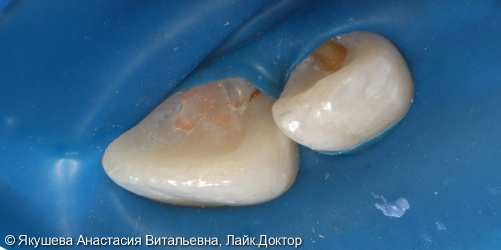 лечение кариеса на небной поверхности 22 зуб - фото №1