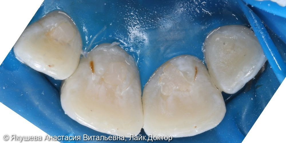 лечение кариеса на небной поверхности 22 зуб - фото №3