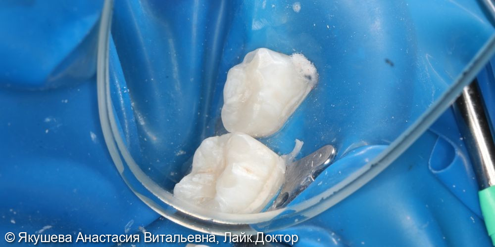 лечение кариеса молочных зубов 74,75 - фото №5