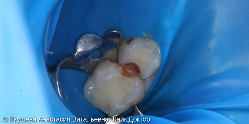 Лечение кариеса молочного зуба 54 при помощи коронки, пациенту 6 лет - фото №1