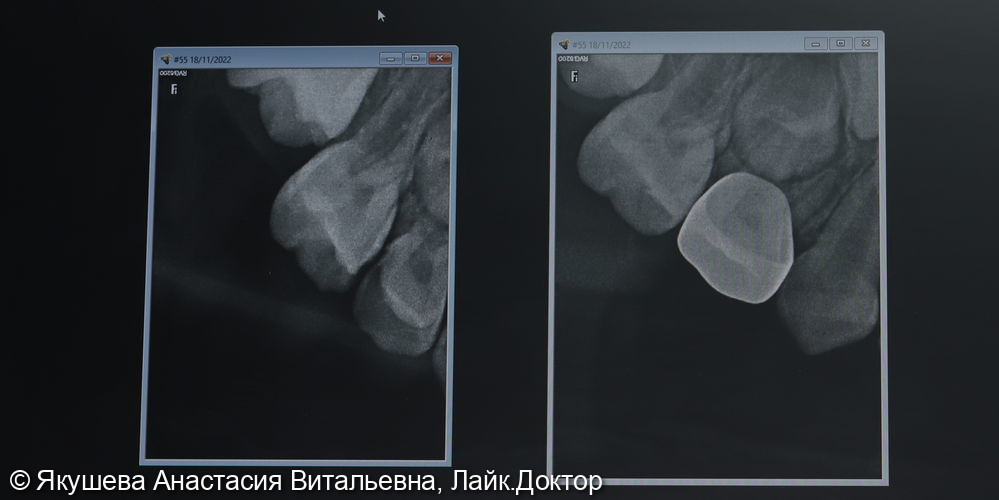 Лечение кариеса молочного зуба 54 при помощи коронки, пациенту 6 лет - фото №4