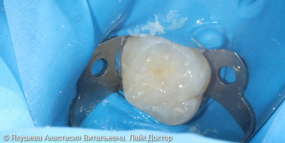 лечение кариеса постоянного зуба 16 - фото №4