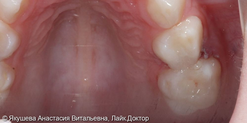 Лечение зубов с применением закись азато-кислородной седации (ЗАКС) - фото №5