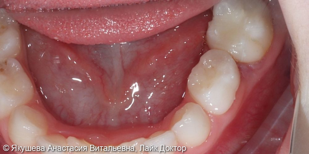 Лечение зубов с применением закись азато-кислородной седации (ЗАКС) - фото №6