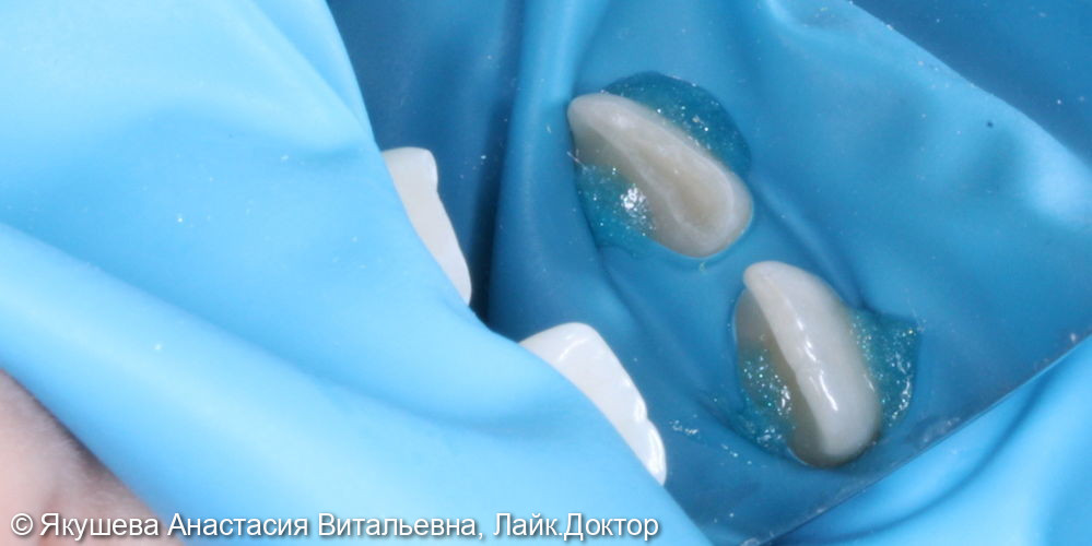 переом коронки зуб в пределах эмали и дентина - фото №1