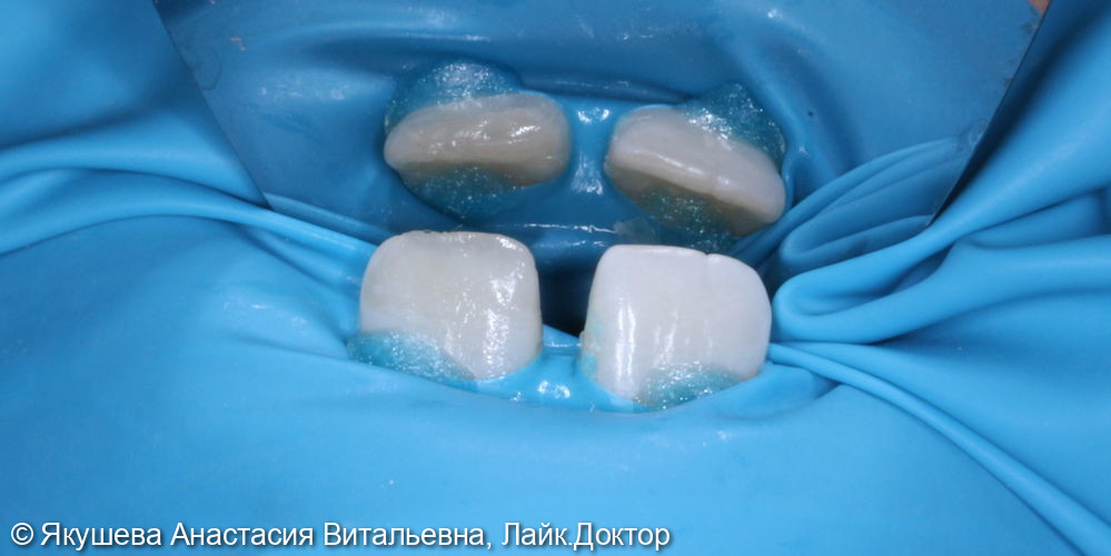 переом коронки зуб в пределах эмали и дентина - фото №2