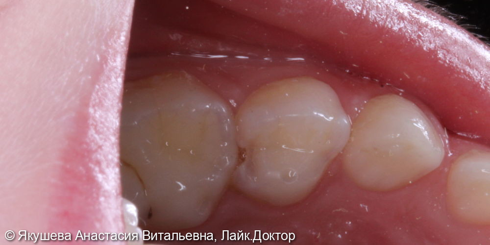 Лечение кариеса молочного зуба - фото №1