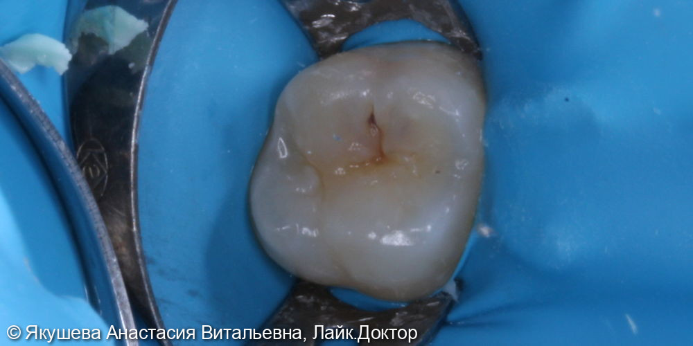 лечение кариеса постоянного зуба - фото №1