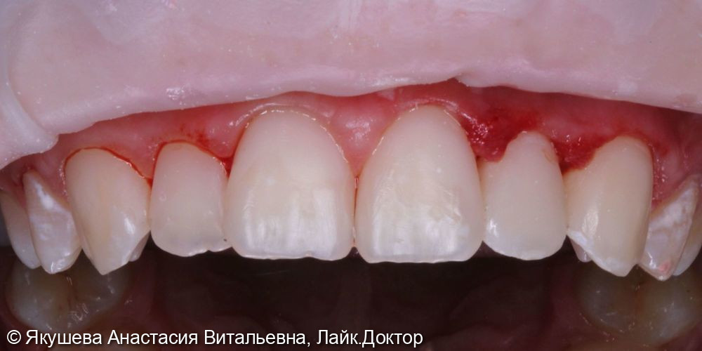 эстетическая реставрация постоянных зубов - фото №2