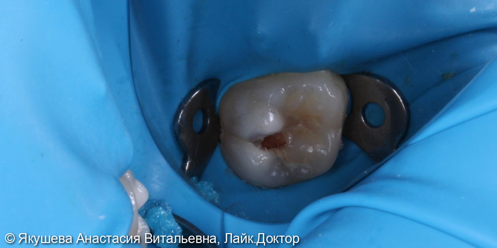 лечение глубокого и скрытого кариеса постоянного зуба - фото №1