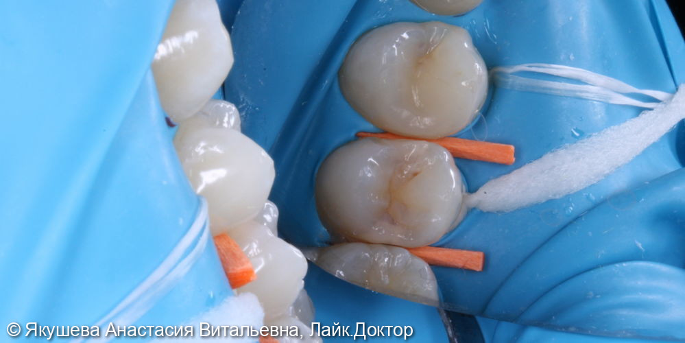 лечение скрытого кариеса на боковых поверхностях постоянного зуба - фото №1