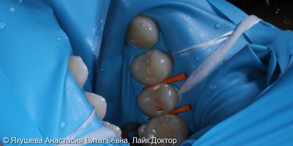 лечение скрытого кариеса на боковых поверхностях постоянного зуба - фото №2