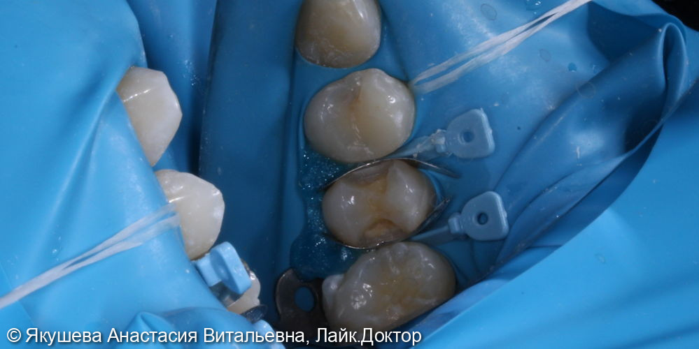 лечение скрытого кариеса на боковых поверхностях постоянного зуба - фото №3