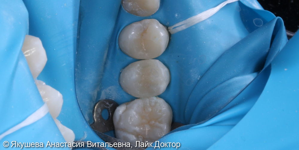 лечение скрытого кариеса на боковых поверхностях постоянного зуба - фото №4