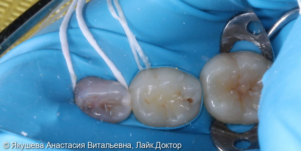 лечение скрытого кариеса постоянного зуба 36 под увеличением - фото №1