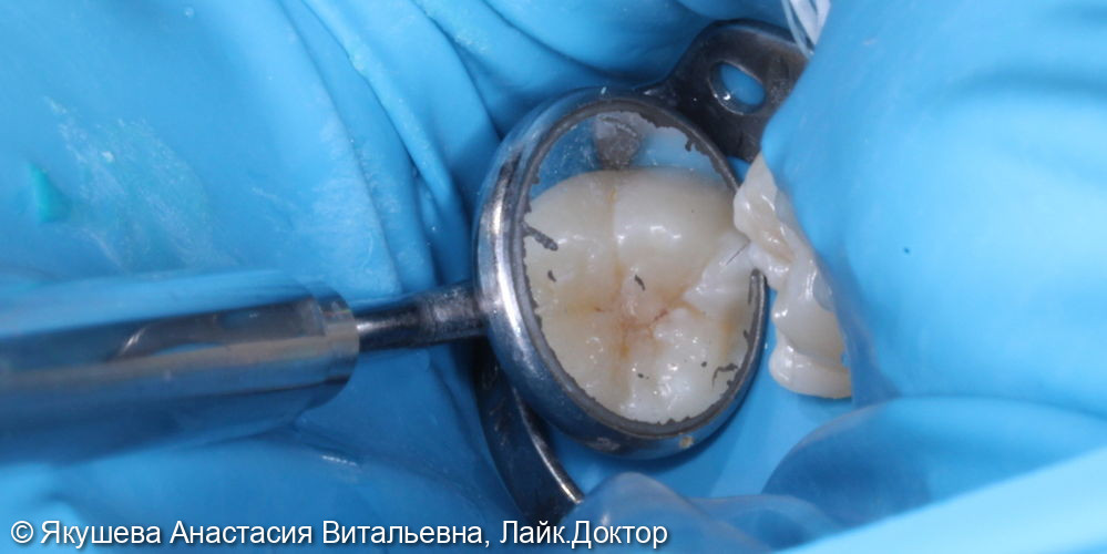 лечение скрытого кариеса постоянного зуба 36 под увеличением - фото №2