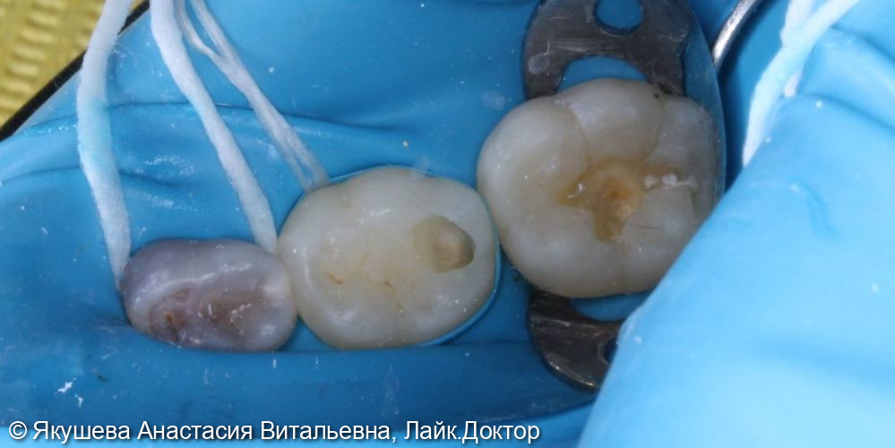лечение скрытого кариеса постоянного зуба 36 под увеличением - фото №4