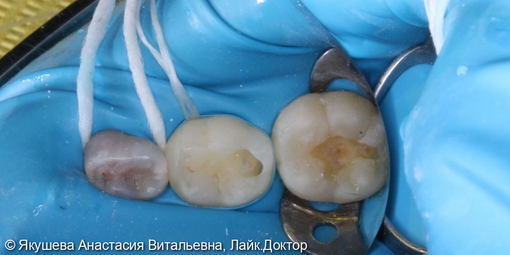 лечение скрытого кариеса постоянного зуба 36 под увеличением - фото №5
