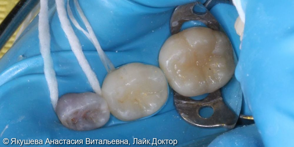 лечение скрытого кариеса постоянного зуба 36 под увеличением - фото №6