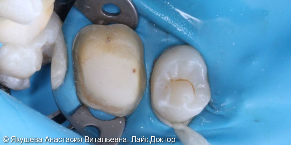 восстановление постоянного зуба циркониевой коронкой - фото №1