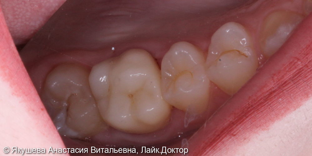 восстановление постоянного зуба циркониевой коронкой - фото №2