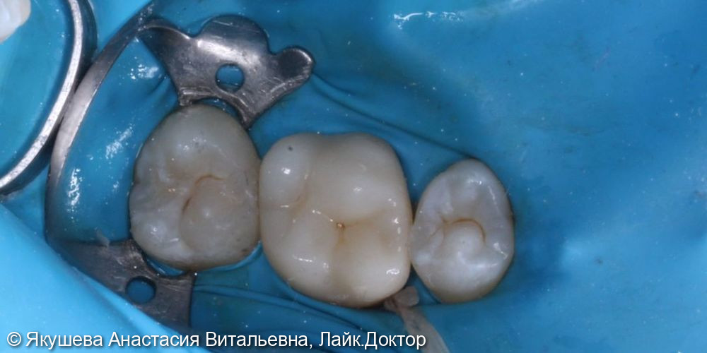 восстановление постоянного зуба циркониевой коронкой - фото №3