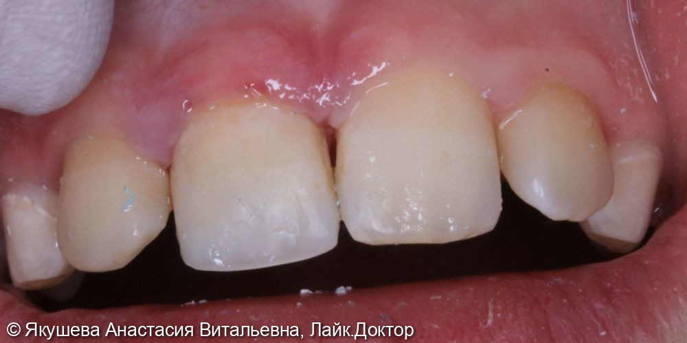 восстановление сломанного зуба - фото №2