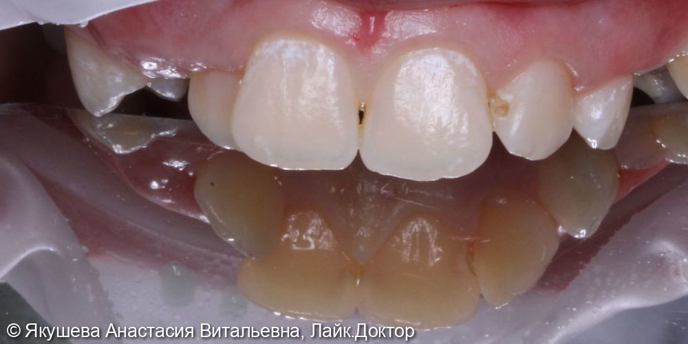 лечение кариеса передних зубов - фото №1