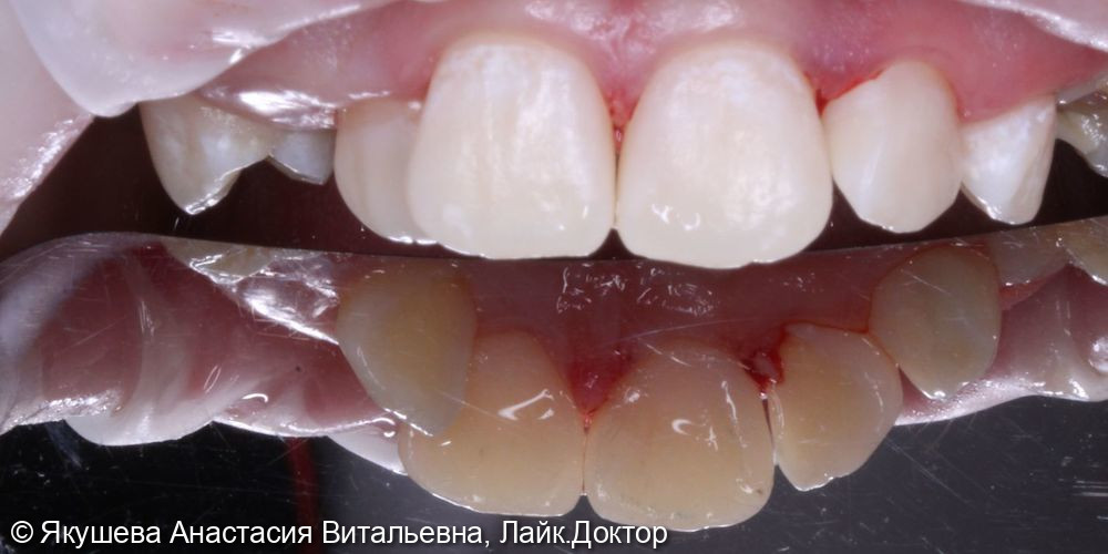 лечение кариеса передних зубов - фото №3