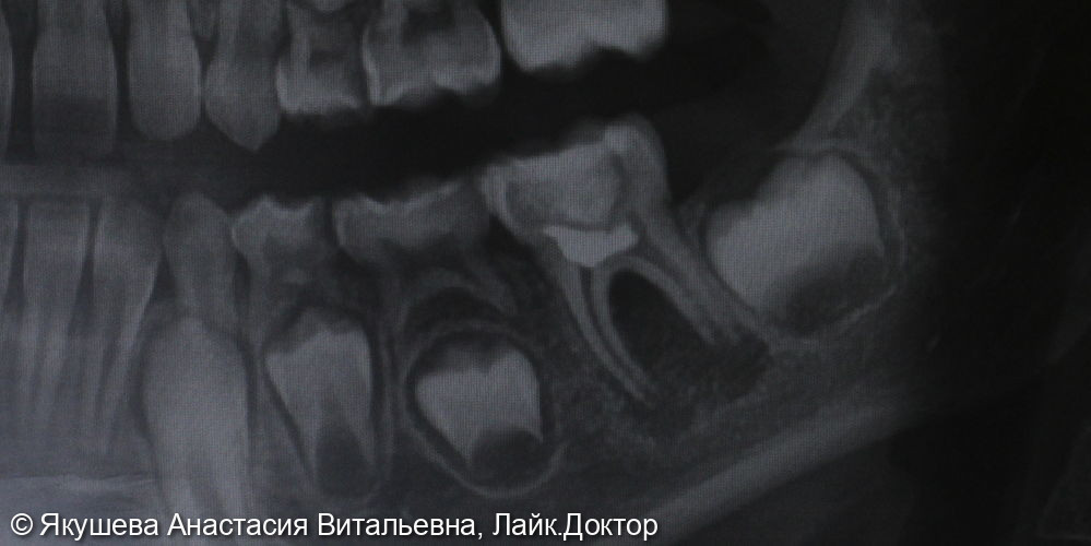 Лечение хронического апикального периодонтита зуб 36 - фото №1
