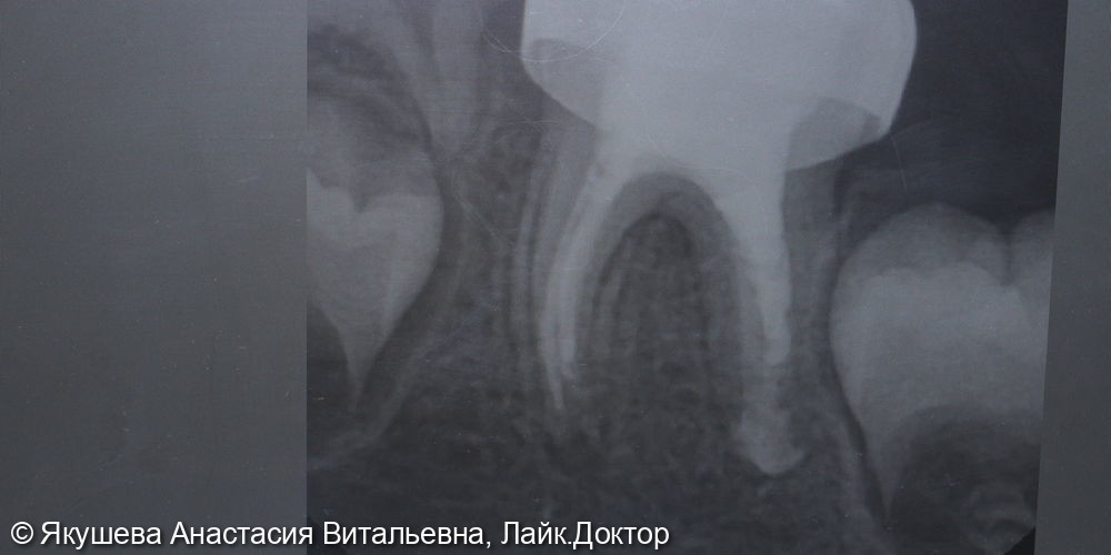 Лечение хронического апикального периодонтита зуб 36 - фото №2