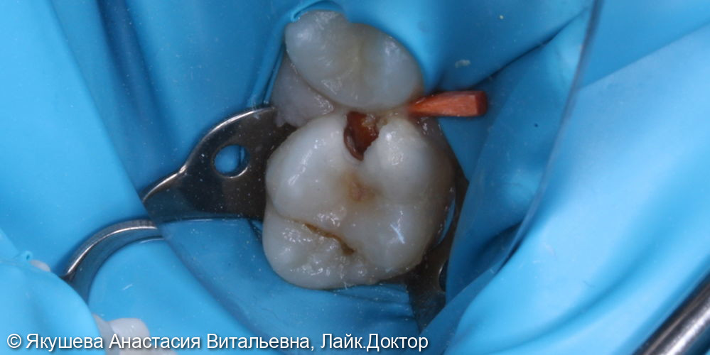 лечение пульпита постоянного зуба 16 с использованием микроскопа. Пациент 10 лет - фото №1