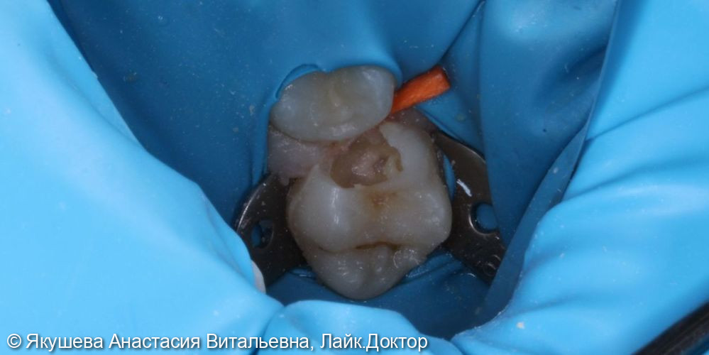лечение пульпита постоянного зуба 16 с использованием микроскопа. Пациент 10 лет - фото №2
