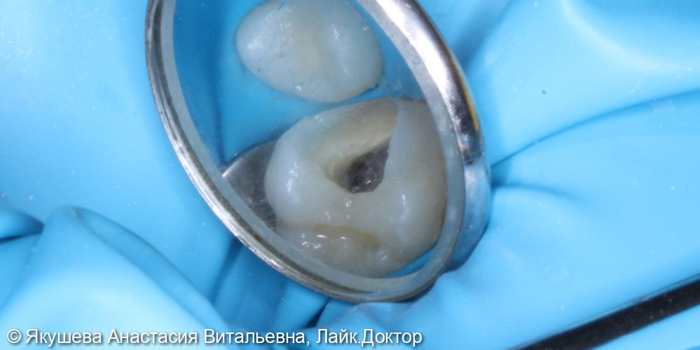 лечение пульпита постоянного зуба 16 с использованием микроскопа. Пациент 10 лет - фото №3