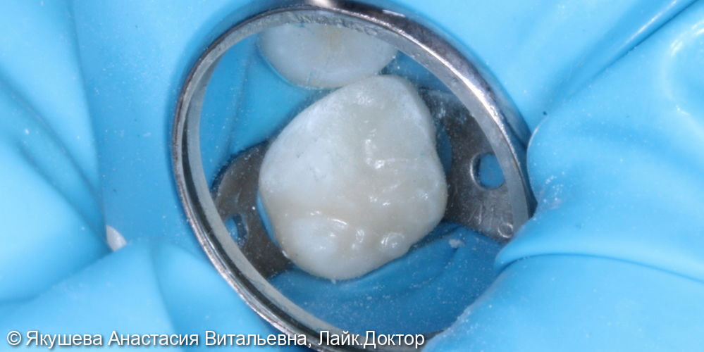 лечение пульпита постоянного зуба 16 с использованием микроскопа. Пациент 10 лет - фото №4